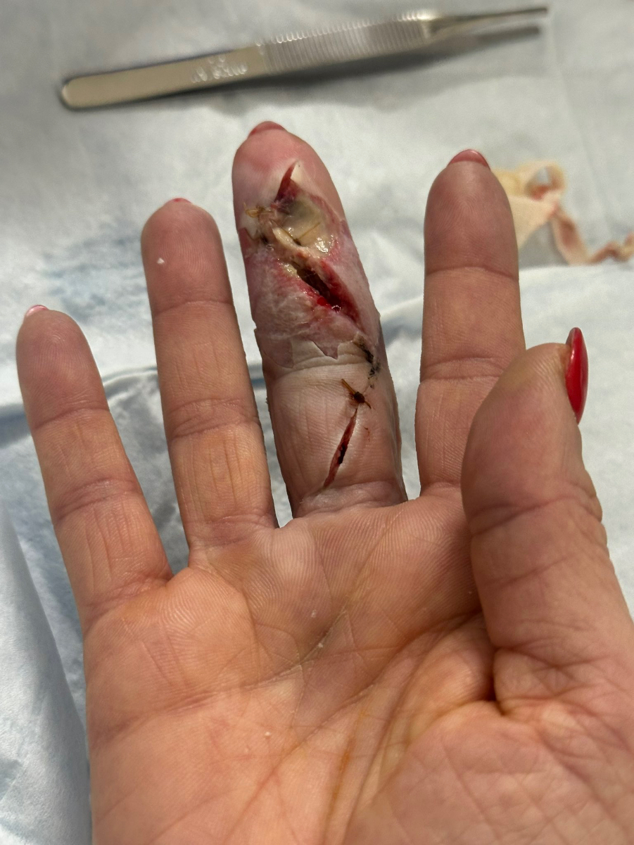 Cj perry infected finger graphic